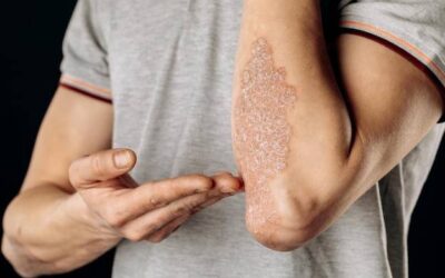 Czy można wyleczyć atopowe zapalenie skóry?