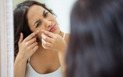 Jak dbać o skórę z zaskórnikami na co dzień?