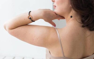 Jak zlikwidować krostki na ramionach bez wizyty u dermatologa?