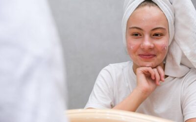 Jakie zabiegi na trądzik u kosmetyczki warto rozważyć?